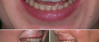улыбка с разных ракурсов перед протезированием зубов
