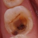 Воспаление пульпы зуба