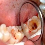 Воспаление в каналах зуба