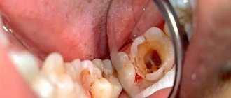 Воспаление в каналах зуба