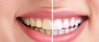 вредно ли отбеливание зубов