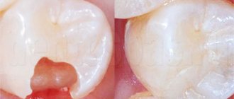 Зуб до и после пломбировки