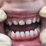 Зубной налет налет может перерасти в камень