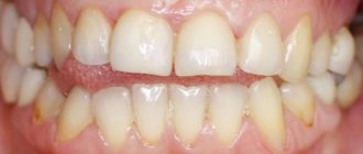 Зубы до восстановления
