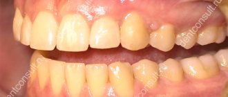 зубы желтые
